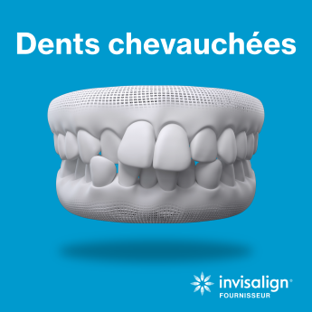 Dents chevauchées